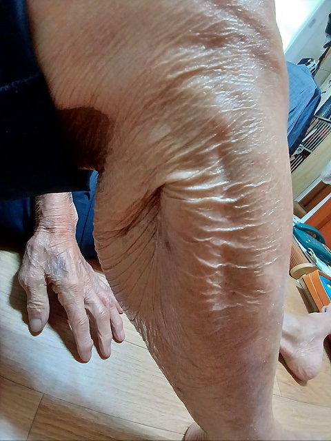 ▲ 6.25 전쟁 중 중공군이 쏜 총탄에 관통당한 오경섭 옹의 다리 모습.ⓒ 오문수